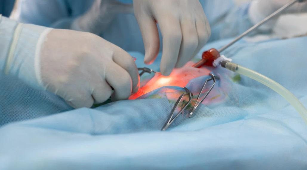 Gastric Sleeve Surgery